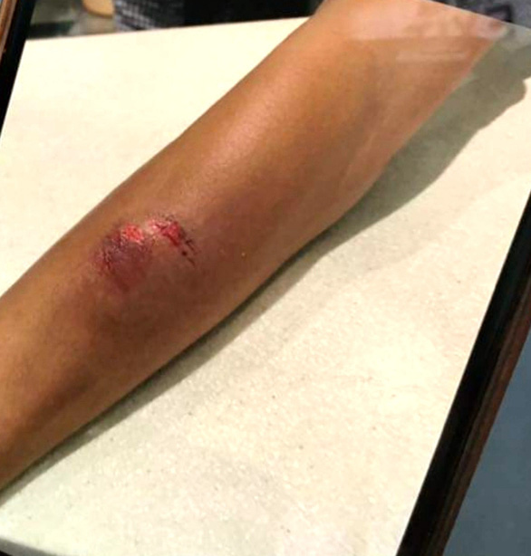 Nhân viên hàng không bị nữ hành khách lao vào cắn tay chảy máu